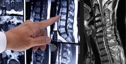 Muguras sāpju diagnoze